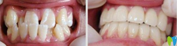 千口百惠巖菊醫(yī)生兒童地包天牙齒矯正案例 千口百惠巖菊醫(yī)生兒童地包天牙齒矯正案例