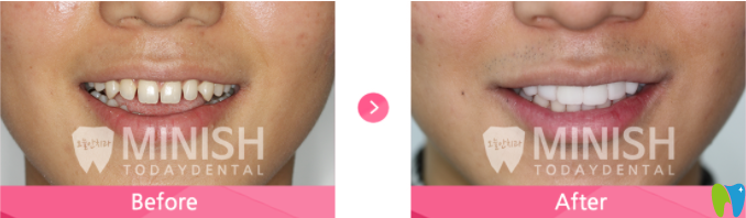 牙齒縫隙大的minish牙齒設計案例前后對比