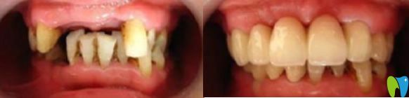 寧波千口百惠口腔半口牙缺失種植案例 寧波千口百惠口腔半口牙缺失種植案例