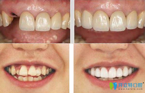 北京瑞泰牙齒矯正及種植牙前后對(duì)比效果圖