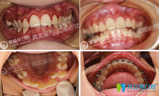 田虎牙齒矯正案例 田虎牙齒矯正案例