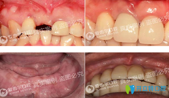 徐安斌單顆牙缺失種植案例+全口牙缺失種植案例 徐安斌單顆牙缺失種植案例+全口牙缺失種植案例