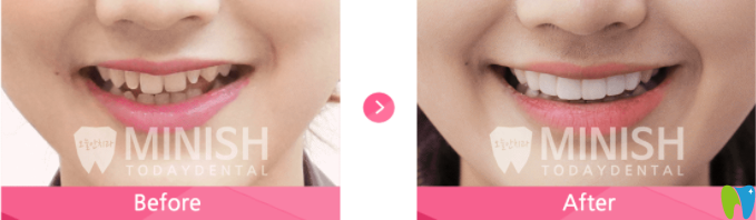 牙齒畸形過小的minish貼面設計前后對比