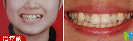 佛山愛(ài)頓口腔靠譜嗎？隱形牙齒矯正6個(gè)月的效果圖來(lái)見(jiàn)證