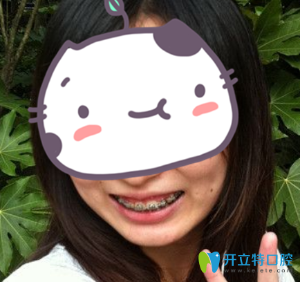 在武漢愛(ài)齒爾口腔做金屬托槽矯正4個(gè)月照片 在武漢愛(ài)齒爾口腔做金屬托槽矯正4個(gè)月照片