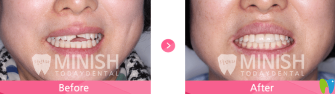 牙齒斷裂的minish設計前后對比圖片