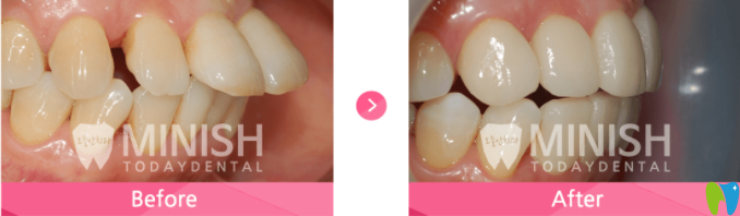 牙齒突出的minish設計前后對比