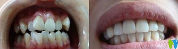 巖菊醫(yī)生牙齒矯正代表案例 巖菊醫(yī)生牙齒矯正代表案例