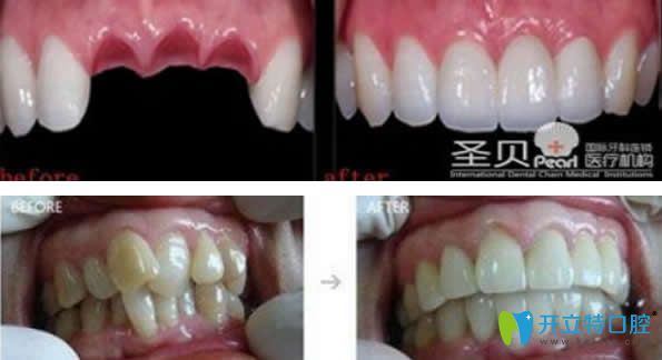 成都圣貝口腔種植牙+牙齒矯正效果<span style= 成都圣貝口腔種植牙+牙齒矯正效果<span style=