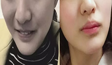 00后的我來(lái)分享在北京康貝佳口腔做牙齒矯正半年來(lái)變化過(guò)程