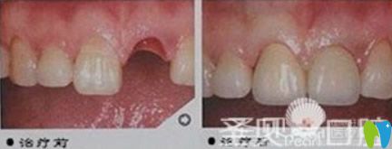 圣貝口腔黃祎銘醫(yī)生單顆牙缺失種植效果<span style=