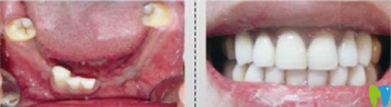 千口百惠口腔種植牙案例 千口百惠口腔種植牙案例