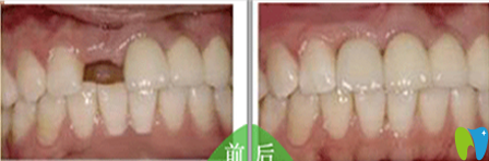 嘉和口腔種植牙前后效果對(duì)比圖