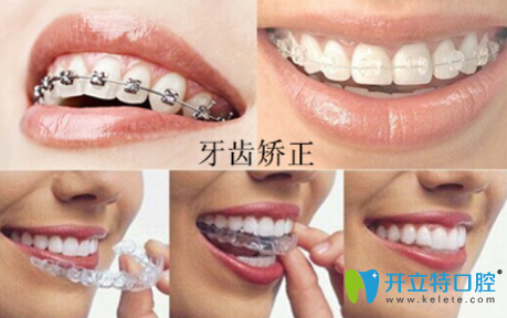 周佩佩科普：“牙齒矯正的年齡是什么時(shí)候？”