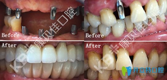康貝佳院長李振芳多顆牙缺失CT親骨種植技術(shù)修復(fù)+單顆牙缺失即刻種植案例