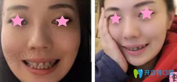 陶瓷半透明隱形矯正帶牙套