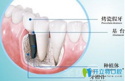 　種植牙由種植體基臺烤瓷冠三部分組成部分