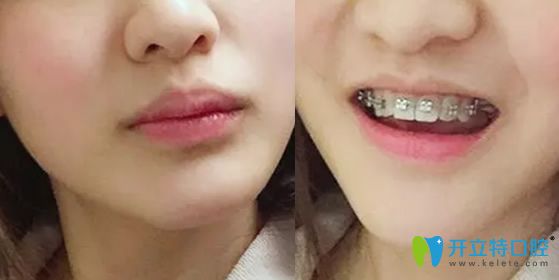 去北京康貝佳口腔做帶牙套半年照