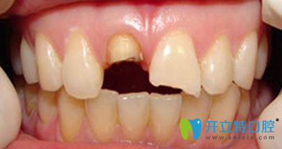 種植牙能現(xiàn)拔現(xiàn)種嗎？分享北京嘉和口腔即刻種植真人案例