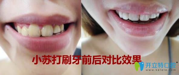 小蘇打刷牙后的前后對(duì)比效果