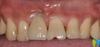 北京嘉和口腔即拔即種術(shù)后效果