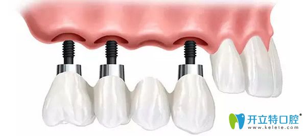 種植牙壽命與周?chē)徰烙泻艽箨P(guān)系