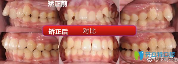 北京瑞泰口腔<!--<i data=20240703-sp></i>-->牙齒擁擠矯正前后對比照