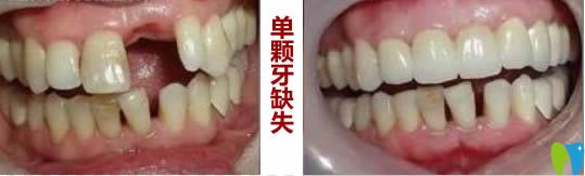 北京瑞泰口腔單顆牙科缺失種植前后對比效果