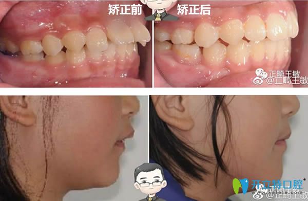 北京瑞泰<!--<i data=20240703-sp></i>-->醫(yī)生下巴后縮矯正前后對比效果