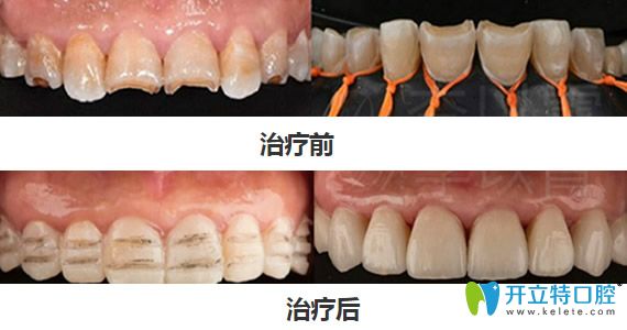 弘和齒科李以霄超薄仿生瓷貼面牙齒修復(fù)案例