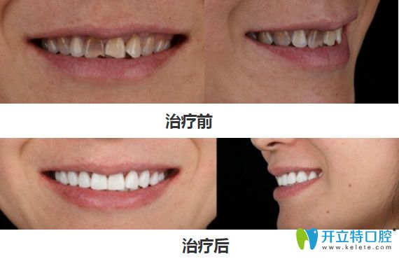 深圳弘和口腔四環(huán)素貼面修復(fù)案例對(duì)比圖