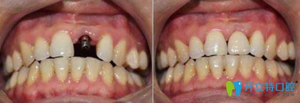 北京瑞泰口腔郭航醫(yī)生種植牙前后對(duì)比效果