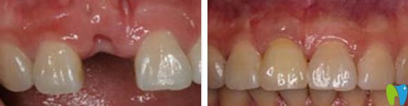 單顆門牙缺失在韋博口腔的種植效果