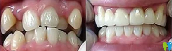 深圳韋博口腔矯正牙齒前后效果對比圖