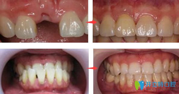 麥芽口腔單顆牙缺失種植+牙齒矯正效果案例