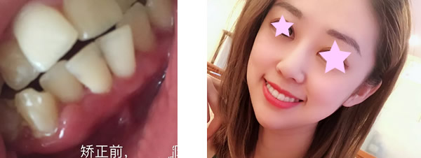我在惠州麥芽口腔矯正牙齒 不想做鋼牙妹所以選了隱形正畸
