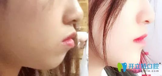 牙齒矯正能改變臉行嗎？看佳美口腔牙齒矯正前后對比照片知