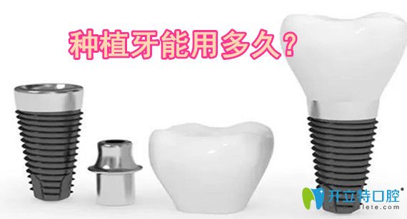 鄭建偉告訴你：種植牙能用多久