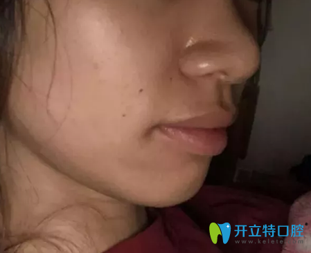 在深圳弘和口腔做牙齒正畸第400天效果圖展示