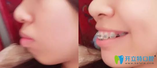 剛開始在深圳弘和口腔戴牙套照片