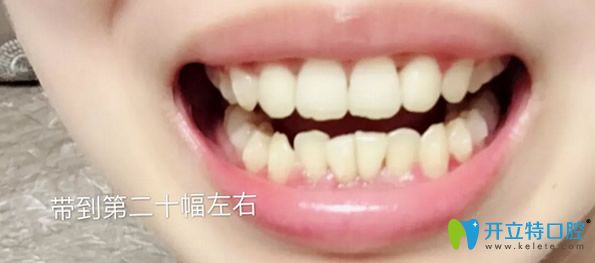 瑞德口腔矯正牙齒14個月恢復效果
