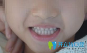沒有在重慶德亞口腔做牙齒矯正前乳牙情況 沒有在重慶德亞口腔做牙齒矯正前乳牙情況