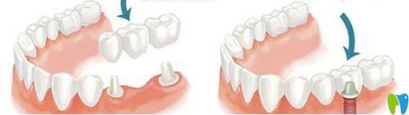 修復(fù)缺失牙的方法有鑲牙烤瓷牙種植牙