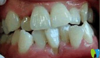 杭州牙科矯正牙齒前