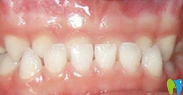 <!--<i data=20240703-sp></i>-->美奧口腔隱形正畸前