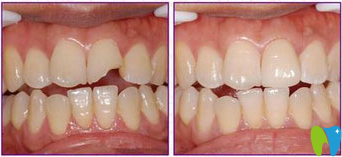 牙齒碎了一小塊怎么辦還會(huì)長嗎 能補(bǔ)嗎 答案都在這里