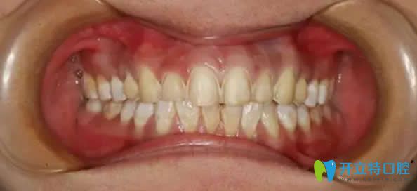 華美口腔制作臨時(shí)牙貼面