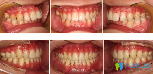 矯正牙齒前后效果對比案例 矯正牙齒前后效果對比案例