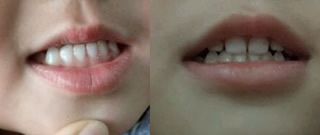 3歲女兒在西安雁塔惟真口腔矯正“地包天”30天來的記錄