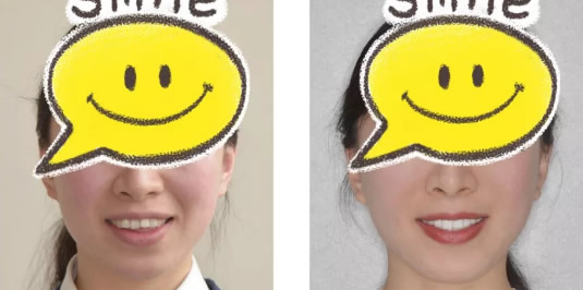 上海美樂(lè)口腔矯正牙齒怎么樣 25歲正畸案例+前后對(duì)比照見(jiàn)證